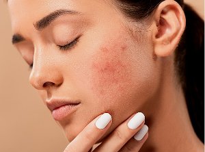 How to Get Rid of Post-Acne Marks on Your Face and Body